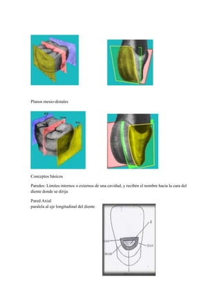 Planos mesio-distales

Conceptos básicos
Paredes: Limites internos o externos de una cavidad, y reciben el nombre hacia la cara del
diente donde se dirija
Pared Axial
paralela al eje longitudinal del diente

 