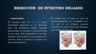 RESECCIÓN DE INTESTINO DELGADO
• Laparoscópica:
El cirujano hace de 3 a 5 cortes
(incisiones) pequeños en su abdomen
bajo. Un dispositivo médico llamado
laparoscopio se introduce a través de uno
de los cortes. Este dispositivo es un tubo
delgado e iluminado con una cámara en el
extremo. Esto le permite al cirujano ver
dentro del abdomen.
• Es posible que se haga un corte de
aproximadamente 2 a 3 pulgadas (5 a
7.5 cm) si el cirujano necesita
introducir la mano dentro del abdomen
para palpar el intestino
 