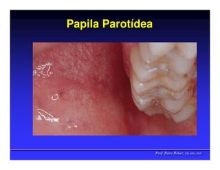 Papila Parotídea
       Parotídea




                   Prof. Peter Reher, CD, MSc, PhD
                   Prof. Peter Reher, CD, MSc, PhD
 