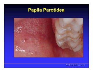 Papila Parotídea
PPrrooff..PPeetteerrRReehheerr,,C
C
D
D
,
,
M
M
S
S
c
c
,
,
P
P
h
h
D
D
 