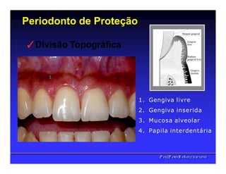 Periodonto de Proteção
✓Divisão Topográfica
3
2
1
4
1. Gengiva livre
2. Gengiva inserida
3. Mucosa alveolar
4. Papila interdentária
PPrrooff..PPeetteerrRReehheerr,,C
C
D
D
,
,
M
M
S
S
c
c
,
,
P
P
h
h
D
D
 