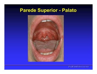 Parede Superior - Palato
PPrrooff..PPeetteerrRReehheerr,,C
C
D
D
,
,
M
M
S
S
c
c
,
,
P
P
h
h
D
D
 