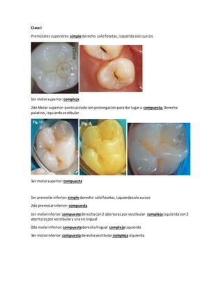 Clase l
Premolaressuperiores: simple derecho solofosetas,izquierdasolosurcos
1er molarsuperior:compleja
2do Molar superior:puntoaisladoconprolongaciónparadar lugara compuesta.Derecha
palatino,izquierdavestibular
3er molarsuperior: compuesta
1er premolarinferior: simple derecho solofosetas,izquierdasolosurcos
2do premolarinferior: compuesta
1er molarinferior: compuestaderechacon2 aberturaspor vestibular complejaizquierdacon2
aberturaspor vestibularyunaenlingual
2do molarinferior: compuestaderechalingual complejaizquierda
3er molarinferior: compuestaderechavestibularcomplejaizquierda
 