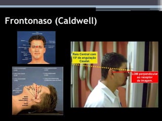 Frontonaso (Caldwell)
 
