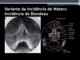 Variante da incidência de Waters-
Incidência de Blondeau
 