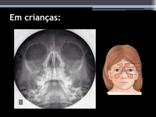 Em crianças:
 
