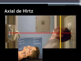 Axial de Hirtz
 