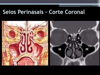 Seios Perinasais – Corte Coronal
 