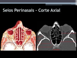 Seios Perinasais – Corte Axial
 