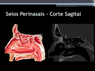 Seios Perinasais – Corte Sagital
 