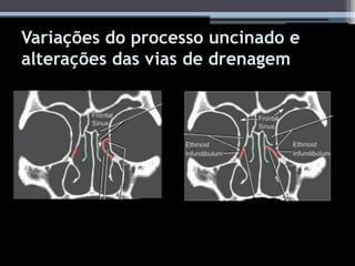 Variações do processo uncinado e
alterações das vias de drenagem
 