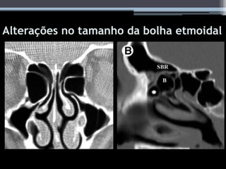 Alterações no tamanho da bolha etmoidal
 