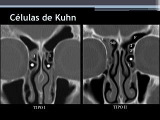 Células de Kuhn
TIPO I TIPO II
 