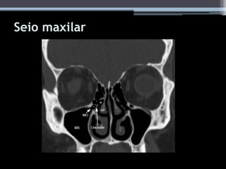 Seio maxilar
 