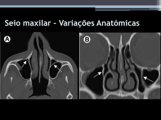 Seio maxilar – Variações Anatómicas
 