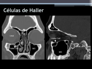Células de Haller
 