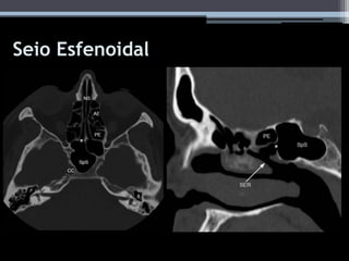 Seio Esfenoidal
 