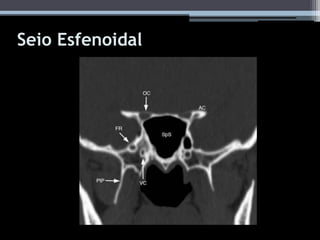 Seio Esfenoidal
 