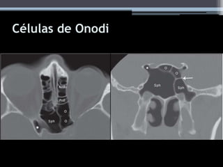 Células de Onodi
 