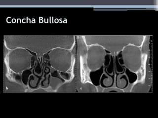 Concha Bullosa
 