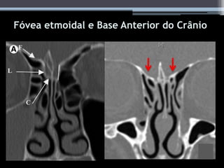 Fóvea etmoidal e Base Anterior do Crânio
 