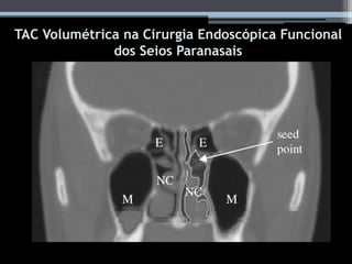 TAC Volumétrica na Cirurgia Endoscópica Funcional
dos Seios Paranasais
 