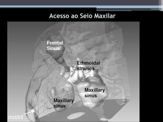 Acesso ao seio maxilar
Acesso ao Seio Maxilar
 