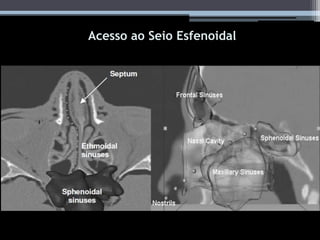 Acesso ao seio esfenoidal
Acesso ao Seio Esfenoidal
 