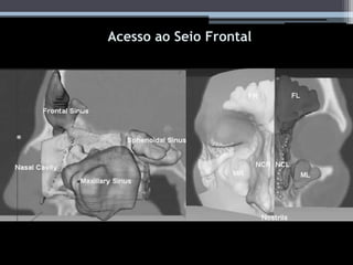 Acesso ao seio frontal
Acesso ao Seio Frontal
 