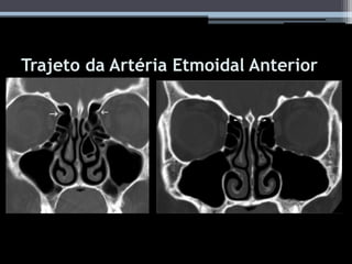 Trajeto da Artéria Etmoidal Anterior
 