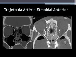 Trajeto da Artéria Etmoidal Anterior
 