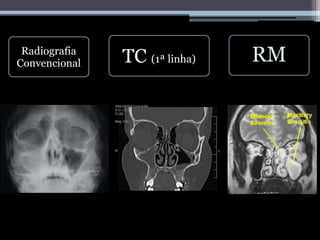 Radiografia
Convencional TC (1ª linha) RM
 