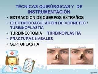 TÉCNICAS QUIRÚRGICAS Y DE
INSTRUMENTACIÓN
• EXTRACCION DE CUERPOS EXTRAÑOS
• ELECTROCOAGULACIÓN DE CORNETES /
TURBINOPLASTIA
• TURBINECTOMIA TURBINOPLASTIA
• FRACTURAS NASALES
• SEPTOPLASTIA
 