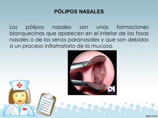 PÓLIPOS NASALES
Los pólipos nasales son unas formaciones
blanquecinas que aparecen en el interior de las fosas
nasales o de los senos paranasales y que son debidos
a un proceso inflamatorio de la mucosa.
 
