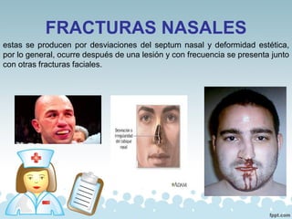 FRACTURAS NASALES
estas se producen por desviaciones del septum nasal y deformidad estética,
por lo general, ocurre después de una lesión y con frecuencia se presenta junto
con otras fracturas faciales.
 