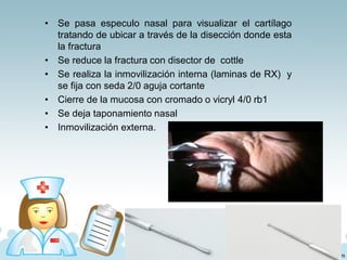 • Se pasa especulo nasal para visualizar el cartílago
tratando de ubicar a través de la disección donde esta
la fractura
• Se reduce la fractura con disector de cottle
• Se realiza la inmovilización interna (laminas de RX) y
se fija con seda 2/0 aguja cortante
• Cierre de la mucosa con cromado o vicryl 4/0 rb1
• Se deja taponamiento nasal
• Inmovilización externa.
 