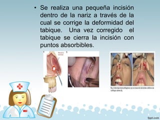 • Se realiza una pequeña incisión
dentro de la nariz a través de la
cual se corrige la deformidad del
tabique. Una vez corregido el
tabique se cierra la incisión con
puntos absorbibles.
 