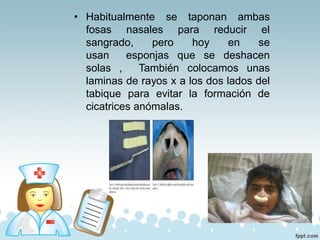 • Habitualmente se taponan ambas
fosas nasales para reducir el
sangrado, pero hoy en se
usan esponjas que se deshacen
solas , También colocamos unas
laminas de rayos x a los dos lados del
tabique para evitar la formación de
cicatrices anómalas.
 