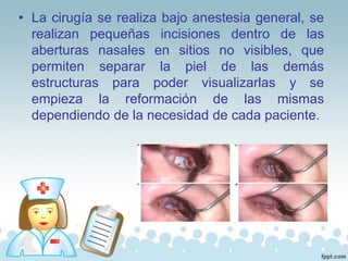 • La cirugía se realiza bajo anestesia general, se
realizan pequeñas incisiones dentro de las
aberturas nasales en sitios no visibles, que
permiten separar la piel de las demás
estructuras para poder visualizarlas y se
empieza la reformación de las mismas
dependiendo de la necesidad de cada paciente.
 