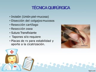 TÉCNICAQUIRÚRGICA
• Incisión (Unión piel-mucosa)
• Disección del colgajosmucosos
• Resección cartílago
• Resección osea
• Sutura Transfixiante
• Tapones silo requiere
• Placas de rx para estabilidad y
aporte a la cicatrización.
 