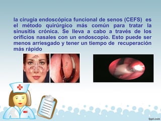 la cirugía endoscópica funcional de senos (CEFS) es
el método quirúrgico más común para tratar la
sinusitis crónica. Se lleva a cabo a través de los
orificios nasales con un endoscopio. Esto puede ser
menos arriesgado y tener un tiempo de recuperación
más rápido
 