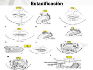 Estadificación
 