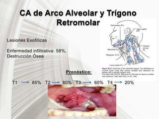 CA de Arco Alveolar y Trígono
Retromolar
Lesiones Exofíticas
Enfermedad infiltrativa: 58%,
Destrucción Ósea
Pronóstico:
T1 85% T2 80% T3 60% T4 20%
 