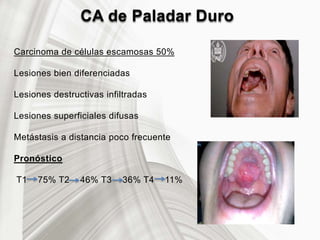 CA de Paladar Duro
Carcinoma de células escamosas 50%
Lesiones bien diferenciadas
Lesiones destructivas infiltradas
Lesiones superficiales difusas
Metástasis a distancia poco frecuente
Pronóstico
T1 75% T2 46% T3 36% T4 11%
 