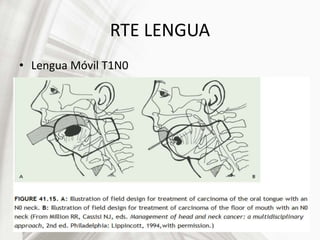 RTE LENGUA
• Lengua Móvil T1N0
 