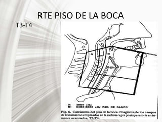 RTE PISO DE LA BOCA
T3-T4
 