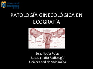 PATOLOGÍA GINECOLÓGICA EN
ECOGRAFÍA
Dra. Nadia Rojas
Becada I año Radiología
Universidad de Valparaíso
 