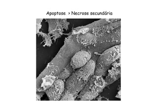 Apoptose > Necrose secundária
 