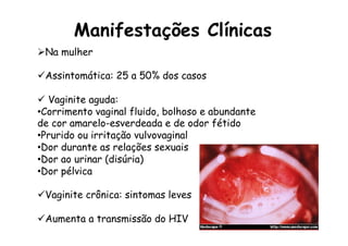 Ø Na mulher
ü Assintomática: 25 a 50% dos casos
ü  Vaginite aguda:
• Corrimento vaginal fluido, bolhoso e abundante
de cor amarelo-esverdeada e de odor fétido
• Prurido ou irritação vulvovaginal
• Dor durante as relações sexuais
• Dor ao urinar (disúria)
• Dor pélvica
ü Vaginite crônica: sintomas leves
ü Aumenta a transmissão do HIV
Manifestações Clínicas
 