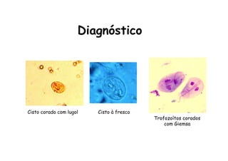 Cisto corado com lugol Cisto à fresco
Trofozoítos corados
com Giemsa
Diagnóstico
 